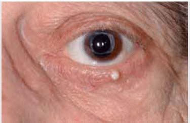 Eyelid Cystic Lesions Simulating Neoplasms | Ento Key