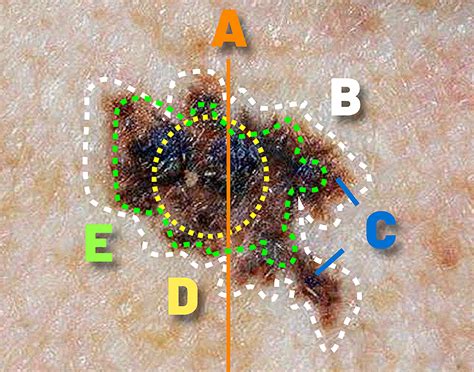 How to identify Melanoma: Diagnosis, Stages and Expert Treatment