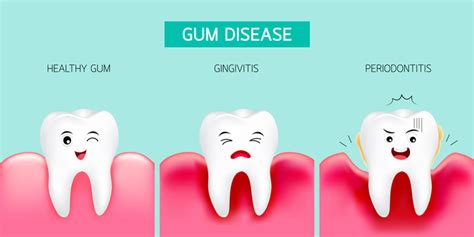 Gum Disease Cartoon Images – Browse 2,105 Stock Photos, Vectors, and ...