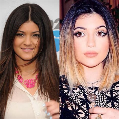 Kylie Jenner Plastic Surgery Before And After Nose Job, Lip Injections ...