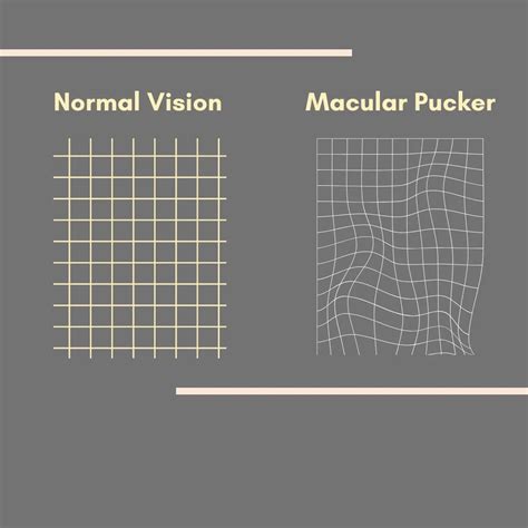 Epiretinal Membrane (Macular Pucker): Causes, Symptoms, and Treatment ...