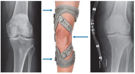 Unloader Knee Brace | Osteoarthritis Support | Orthotics Plus Melbourne ...