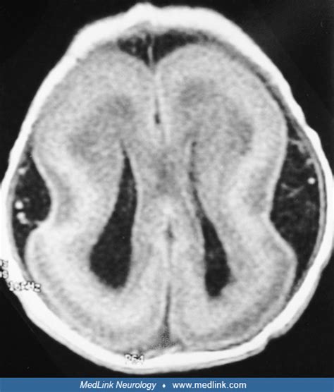 Lissencephalies | MedLink Neurology