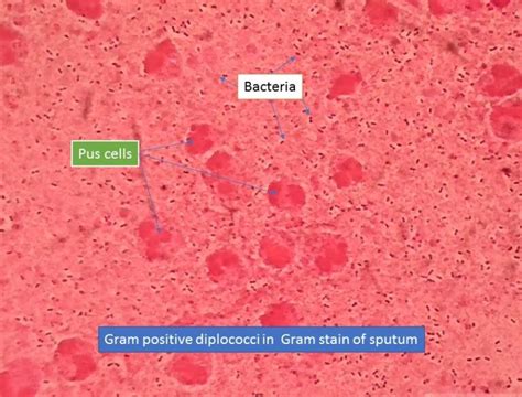 Gram positive diplococci in Gram stain of sputum - universe84a