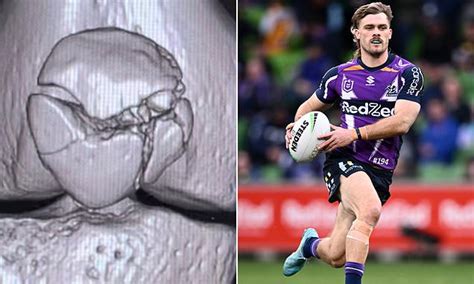 Gruesome extent of the damage to Melbourne Storm star Ryan Papenhuyzen ...