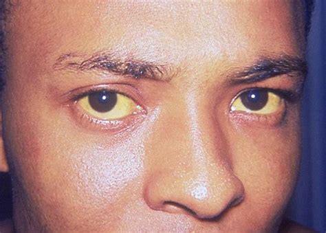 Jaundice | Description, Symptoms, Causes, & Treatment | Britannica