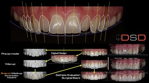 Smile Makeover Design at Mona Vale Dental