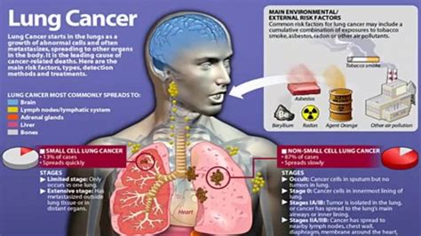 Asbestos Lung Cancer - YouTube