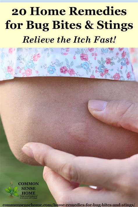 20 Home Remedies for Bug Bites and Stings that Itch & Swell