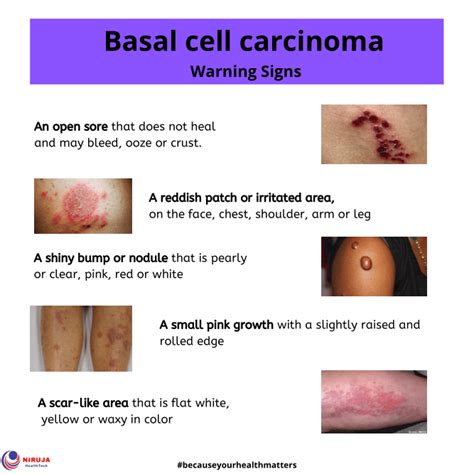 Basal Cell Carcinoma