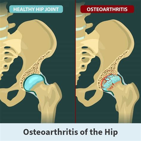 Osteophytes Hip