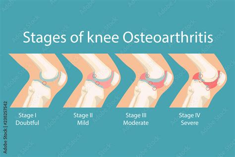 Vetor de Stages of knee Osteoarthritis. Human Knee Osteoarthritis ...