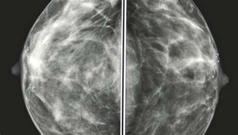 Mammogram images: Normal, abnormal, and breast cancer