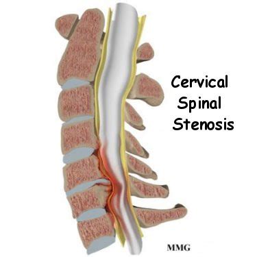 Cervical Spinal Stenosis - Orthogate