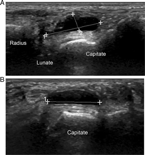 Ganglion Cyst Wrist Ultrasound