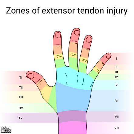 Zone classification of extensor tendon injury | Radiology Reference ...