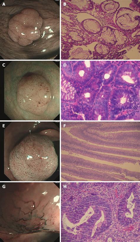 Narrow-band imaging endoscopy with and without magnification in ...