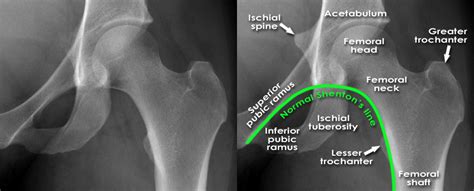 Femoral Head And Neck