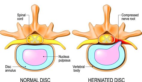 Intervertebral Discs: Structure, Function, and Disorders - Spine Info