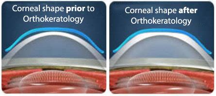 Orthokeratology and Ortho-K Lenses | Optomeyes