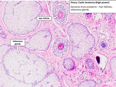 Ovary – Cystic Teratoma – NUS Pathweb :: NUS Pathweb