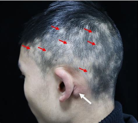 Posterior auricular lymph nodes - gourmetmokasin