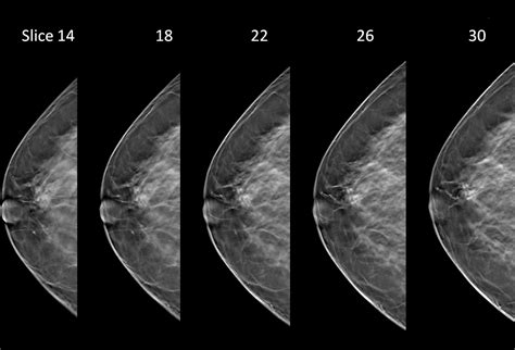 3D Mammography – Harold & Dixie LePere Breast Health Center