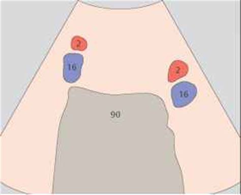 Sonography Aorta Cranially Heart Celiac Branch Sagittal - Ultrasound ...