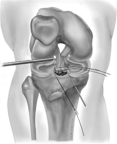 Figure 1 from Tibial eminence fractures. | Semantic Scholar