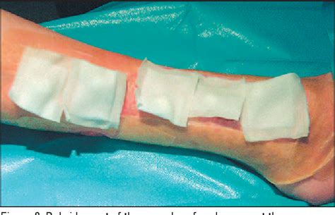 Figure 5 from Maggot therapy for wound healing: clinical relevance ...