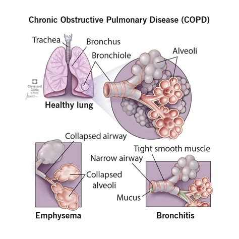 COPD: Causes, Symptoms, Diagnosis, Treatment & Prevention