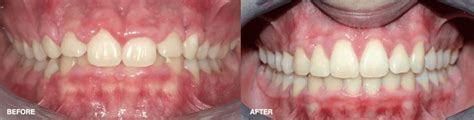 Gingivectomy surgical procedure - before and after pictures | Dental ...