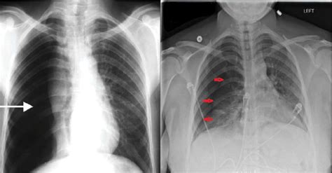 Pneumothorax X Ray : X- Ray Diagnostics Of Pneumothorax: Radiographic ...