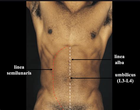 Linea Semilunaris Hernia