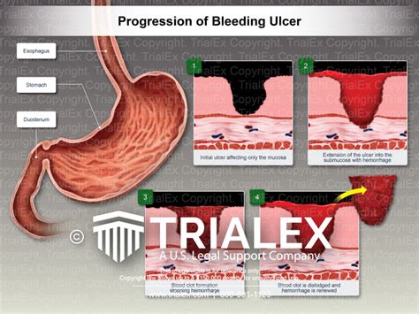 Progression of Bleeding Ulcer - TrialExhibits Inc.