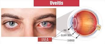 Uveitis: Types, Causes, Symptoms & Treatment » How To Relief