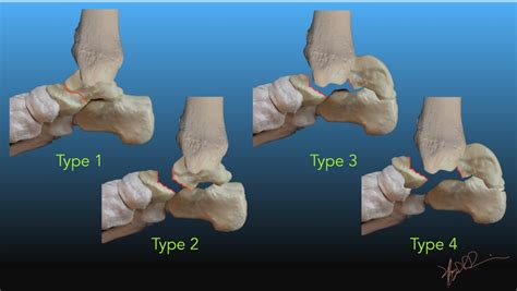 Hawkins Classification of Talar Fractures | UW Emergency Radiology