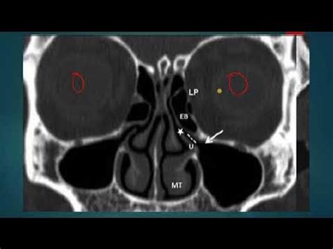 OSTEOMEATAL COMPLEX UNIT (OMC) ON CT ANATOMY SIMPLIFIED - YouTube