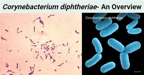 Corynebacterium diphtheriae (Klebs-Löffler bacillus)- An Overview