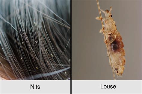 A Guide to Head Lice: Symptoms, Treatments, Prevention | The Healthy