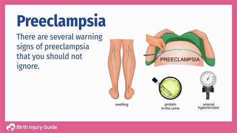 The Genetics Of Pre-Eclampsia, 50% OFF