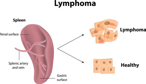 Types Of Lymphoma: What You Need To Know