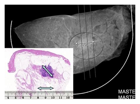 Mastectomy specimen-large-format histopathology correlation: unifocal ...