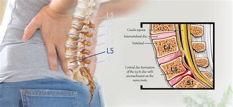 L5-S1 Disc Bulge, Slip Disc, Stenosis & Spondylolisthesis