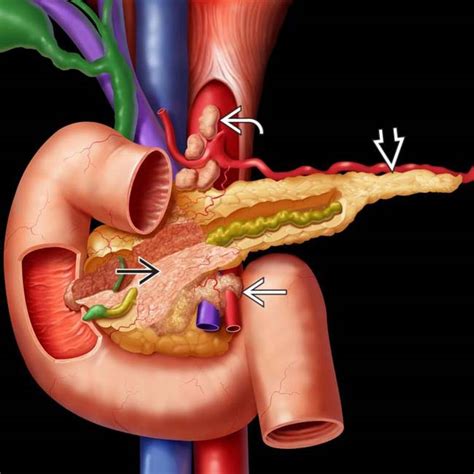 Pancreatic Ductal Carcinoma | Radiology Key