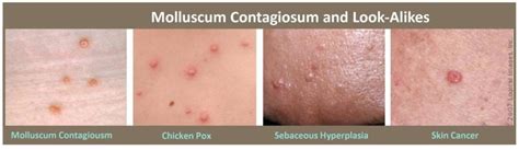 Molluscum Contagiosum Treatment Plano - Skin M.D. and Beyond