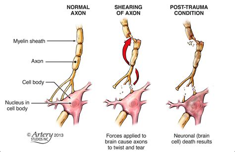 Axonal Shearing