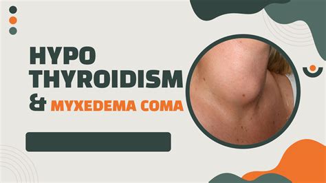 SOLUTION: Hypothyroidism and Myxedema Coma - Studypool