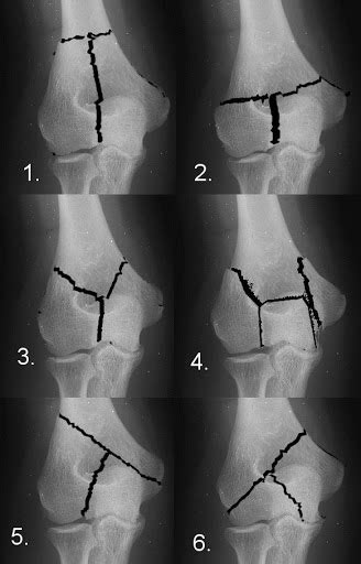 Distal Humerus Anatomy