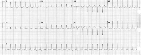 Vagal Maneuvers in SVT: Give 'em a Leg Up! — WashU EM Blog